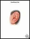 Thumbnail image of: Cauliflower Ear: Illustration