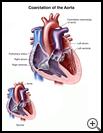 Thumbnail image of: Coarctation of the Aorta: Illustration