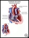 Thumbnail image of: Coarctation of the Aorta: Illustration