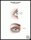 Thumbnail image of: Corneal Abrasion: Illustration