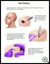 Thumbnail image of: Skin Biopsy: Illustration