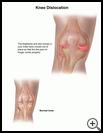 Thumbnail image of: Knee Dislocation: Illustration