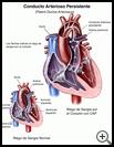 Thumbnail image of: Patent Ductus Arteriosus: Illustration