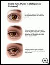 Thumbnail image of: Eyelid Turns Out or In (Ectropion or Entropion): Illustration