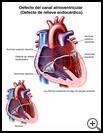 Thumbnail image of: Endocardial Cushion Defect: Illustration