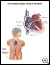 Thumbnail image of: Electrophysiologic Study (EPS): Illustration