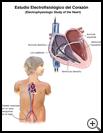 Thumbnail image of: Electrophysiologic Study (EPS): Illustration
