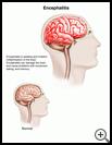 Thumbnail image of: Encephalitis: Illustration