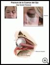 Thumbnail image of: Eye Socket Fracture: Illustration