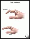 Thumbnail image of: Finger Dislocation: Illustration