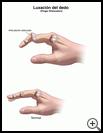 Thumbnail image of: Finger Dislocation: Illustration