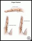 Thumbnail image of: Finger Fracture: Illustration