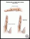 Thumbnail image of: Finger Fracture: Illustration