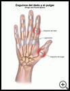 Thumbnail image of: Finger and Thumb Sprain: Illustration