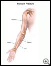 Thumbnail image of: Forearm Fracture: Illustration