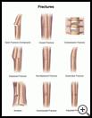 Thumbnail image of: Fractures: Illustration