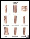 Thumbnail image of: Fractures: Illustration