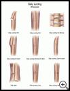 Thumbnail image of: Fractures: Illustration