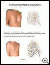 Thumbnail image of: Funnel Chest: Illustration