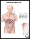 Thumbnail image of: Gastrostomy Feeding Tube: Illustration