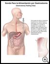 Thumbnail image of: Gastrostomy Feeding Tube: Illustration