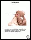 Thumbnail image of: Hemangioma: Illustration