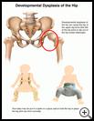 Thumbnail image of: Developmental Hip Dysplasia: Illustration