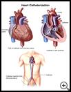 Thumbnail image of: Heart Catheterization: Illustration
