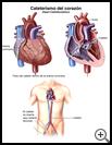 Thumbnail image of: Heart Catheterization: Illustration