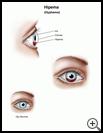 Thumbnail image of: Hyphema: Illustration