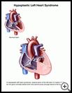 Thumbnail image of: Hypoplastic Left Heart Syndrome: Illustration