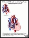 Thumbnail image of: Hypoplastic Left Heart Syndrome: Illustration