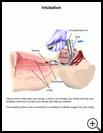Thumbnail image of: Intubation: Illustration