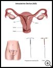 Thumbnail image of: Intrauterine Device (IUD): Illustration