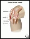 Thumbnail image of: Osgood-Schlatter Disease: Illustration