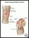 Thumbnail image of: Kneecap (Patellar) Fracture: Illustration