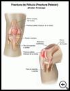 Thumbnail image of: Kneecap (Patellar) Fracture: Illustration