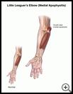 Thumbnail image of: Little Leaguer's Elbow (Medial Apophysitis): Illustration