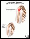 Thumbnail image of: Little Leaguer's Shoulder (Proximal Humeral Epiphysitis): Illustration