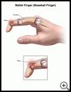 Thumbnail image of: Mallet Finger (Baseball Finger): Illustration