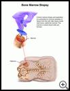 Thumbnail image of: Bone Marrow Biopsy and Aspiration: Illustration