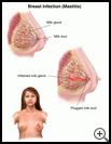 Thumbnail image of: Breast Infection (Mastitis): Illustration