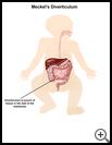 Thumbnail image of: Meckel's Diverticulum: Illustration