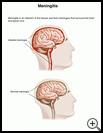 Thumbnail image of: Meningitis: Illustration