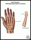 Thumbnail image of: Hand Fracture: Fifth Metacarpal (Boxer's) Fracture: Illustration