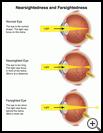 Thumbnail image of: Nearsightedness and Farsightedness: Illustration