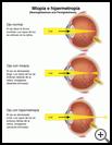 Thumbnail image of: Nearsightedness and Farsightedness: Illustration