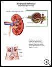 Thumbnail image of: Nephrotic Syndrome: Illustration