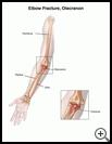 Thumbnail image of: Elbow Fracture: Olecranon Fracture: Illustration