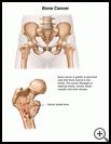 Thumbnail image of: Bone Cancer: Illustration